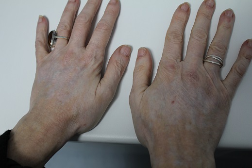 hands after left hand treated with skin booster